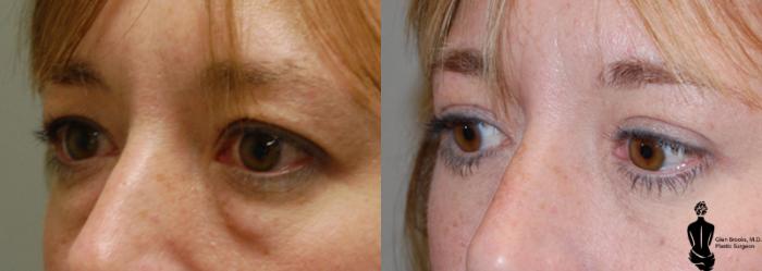 Before & After Blepharoplasty Case 11 View #2 View in Springfield, MA