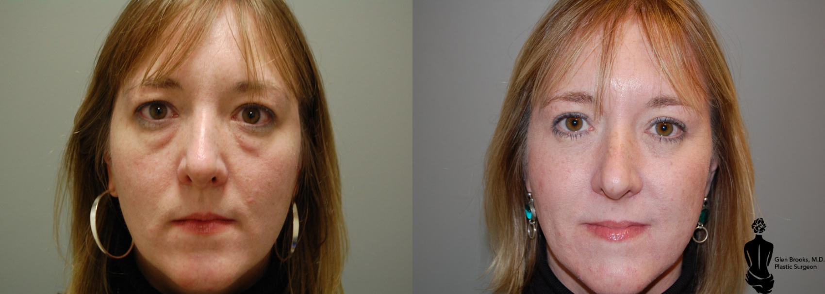 Before & After Blepharoplasty Case 11 View #3 View in Springfield, MA