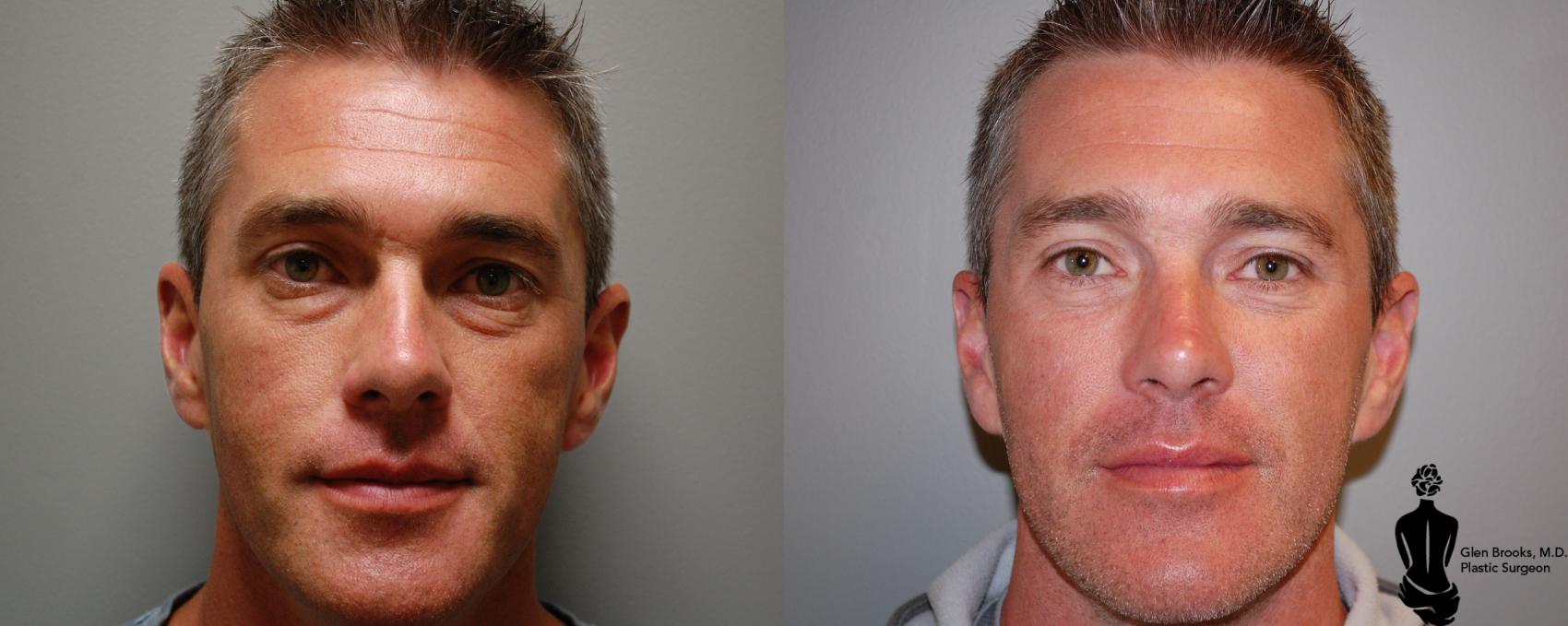 male upper blepharoplasty