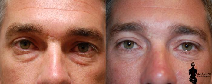 Before & After Blepharoplasty Case 122 View #2 View in Springfield, MA