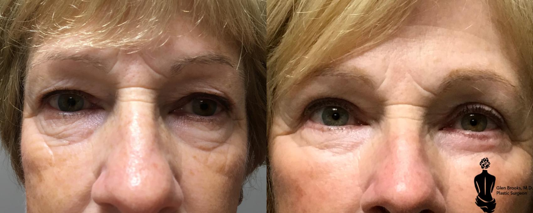 Before & After Blepharoplasty Case 123 View #1 View in Springfield, MA