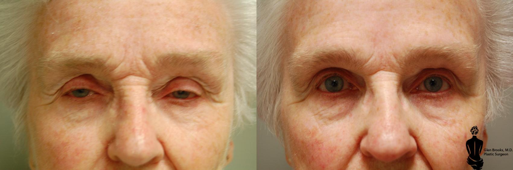Before & After Blepharoplasty Case 36 View #1 View in Springfield, MA