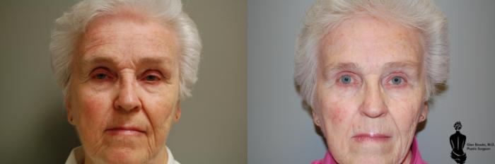 Before & After Blepharoplasty Case 36 View #2 View in Springfield, MA