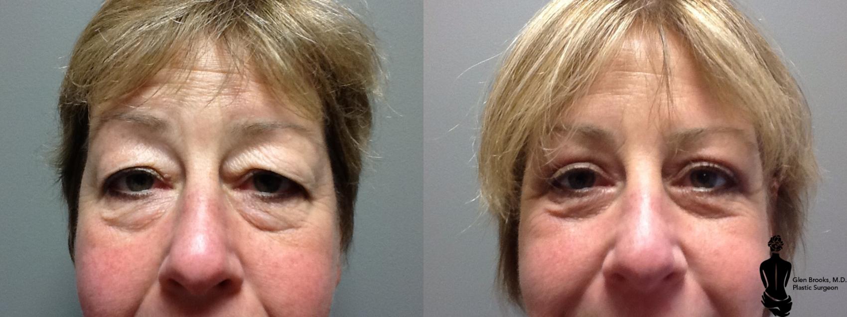 Before & After Blepharoplasty Case 44 View #1 View in Springfield, MA