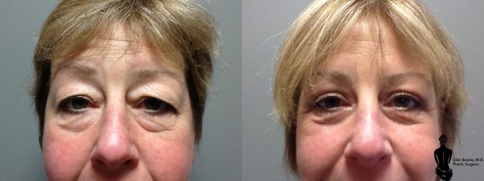 Before & After Blepharoplasty Case 44 View #1 View in Springfield, MA