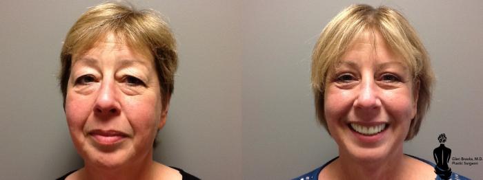Before & After Blepharoplasty Case 44 View #2 View in Springfield, MA
