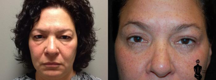 Before & After Blepharoplasty Case 45 View #2 View in Springfield, MA