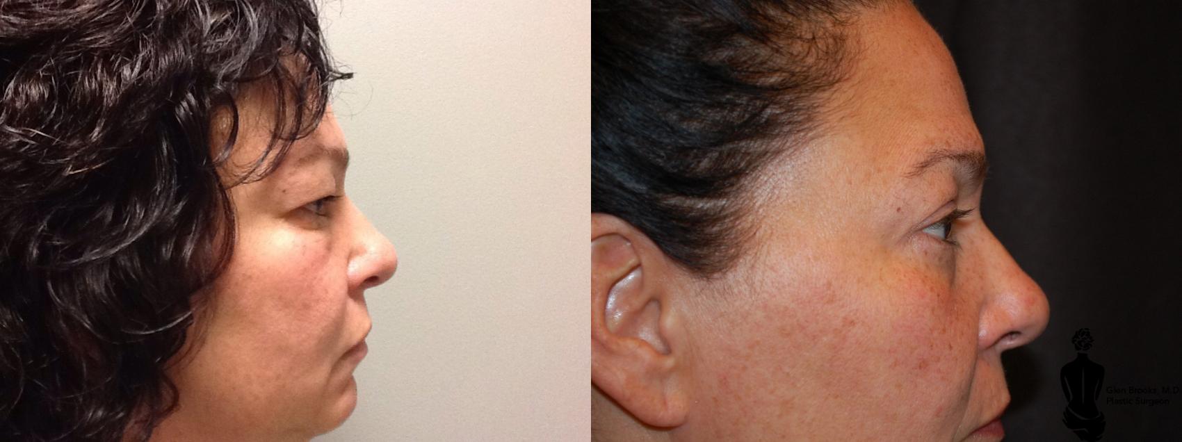 Blepharoplasty Before & After Photo | Springfield, MA | Aesthetic Plastic & Reconstructive Surgery