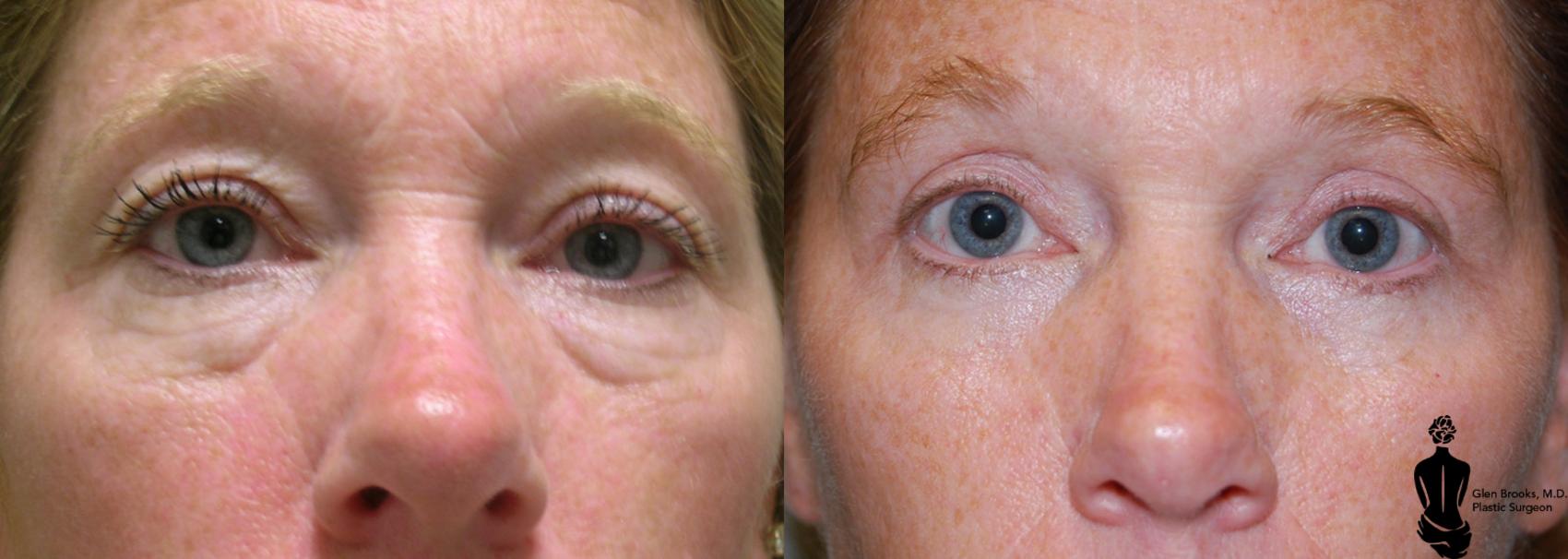 Before & After Blepharoplasty Case 9 View #1 View in Springfield, MA