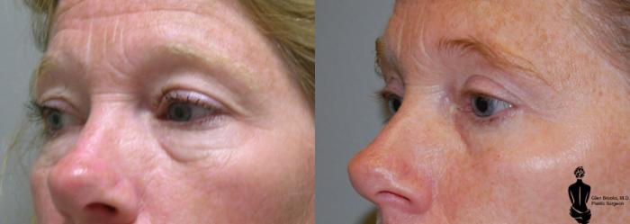 Before & After Blepharoplasty Case 9 View #2 View in Springfield, MA