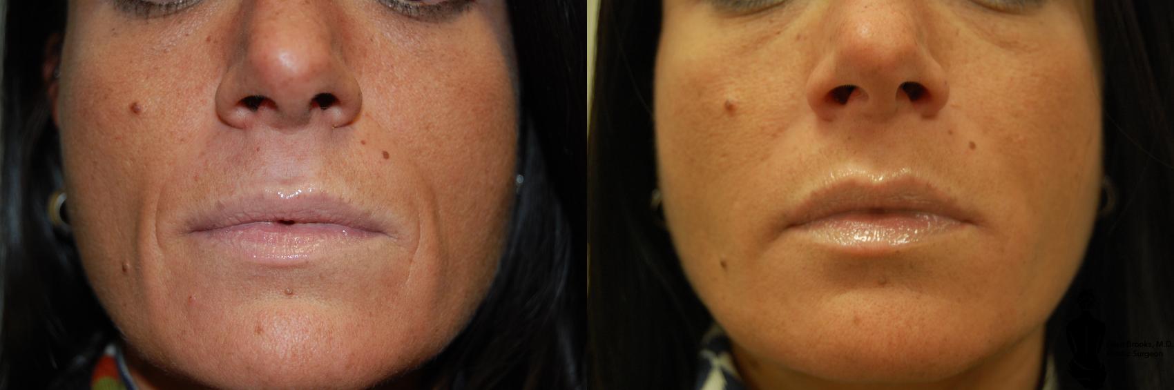 Before & After BOTOX Cosmetic Case 35 View #2 View in Springfield, MA