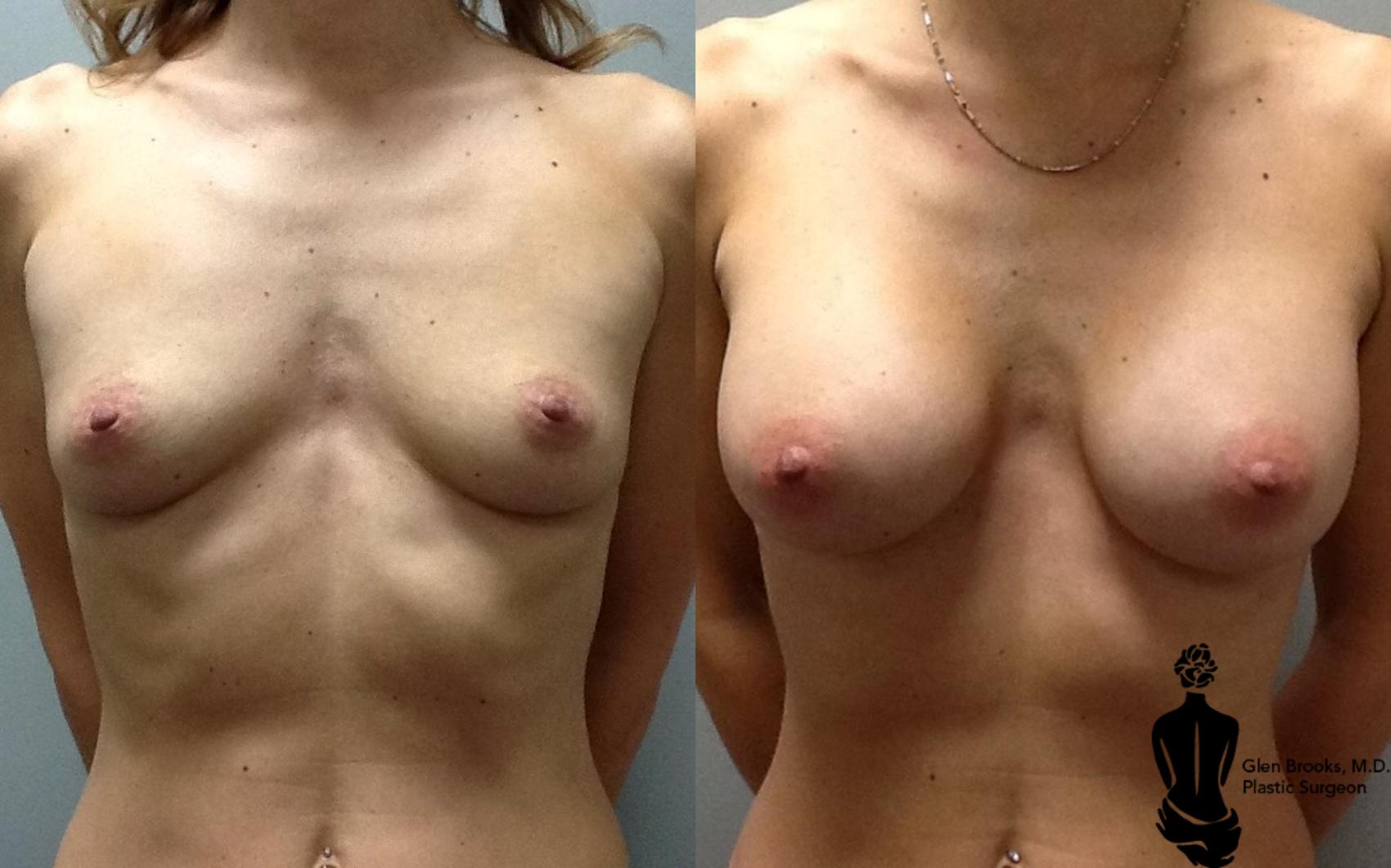 Before & After Breast Augmentation Case 109 View #1 View in Springfield, MA