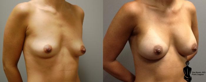 Before & After Breast Augmentation Case 110 View #2 View in Springfield, MA