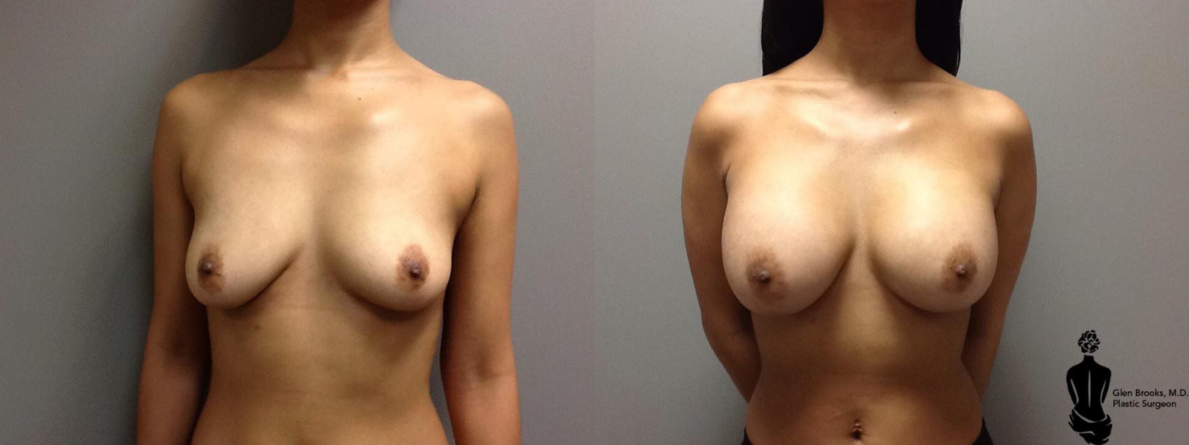 Before & After Breast Augmentation Case 111 View #1 View in Springfield, MA