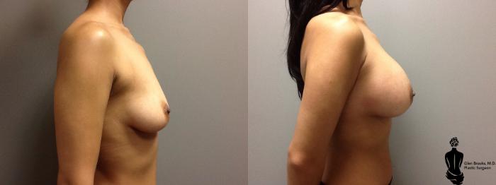 Before & After Breast Augmentation Case 111 View #2 View in Springfield, MA