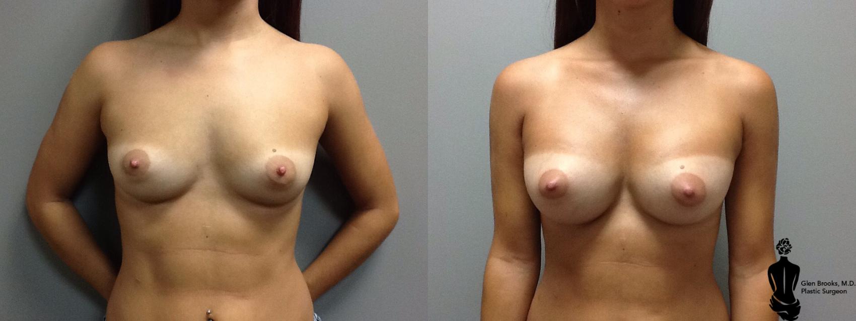 Before & After Breast Augmentation Case 112 View #1 View in Springfield, MA