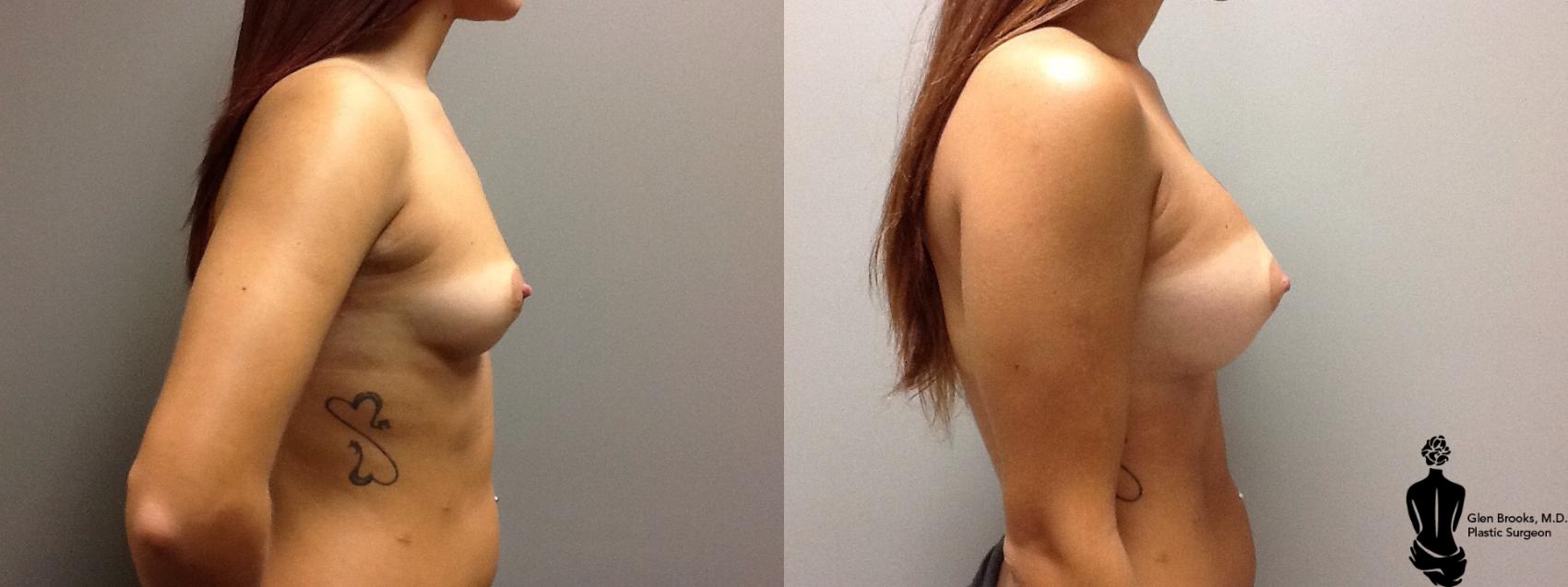 Before & After Breast Augmentation Case 112 View #2 View in Springfield, MA