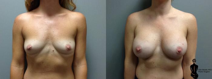 Before & After Breast Augmentation Case 113 View #1 View in Springfield, MA