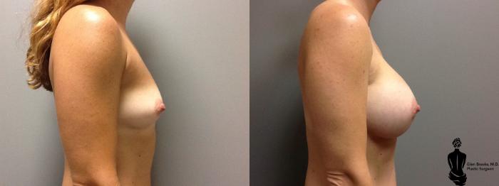 Before & After Breast Augmentation Case 113 View #2 View in Springfield, MA
