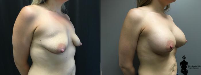 Before & After Breast Augmentation Case 114 View #2 View in Springfield, MA