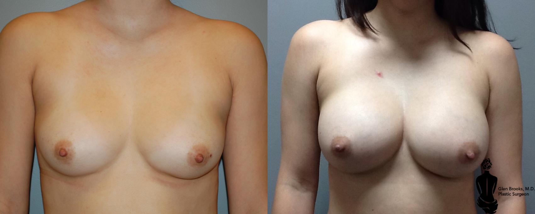 Before & After Breast Augmentation Case 115 View #1 View in Springfield, MA