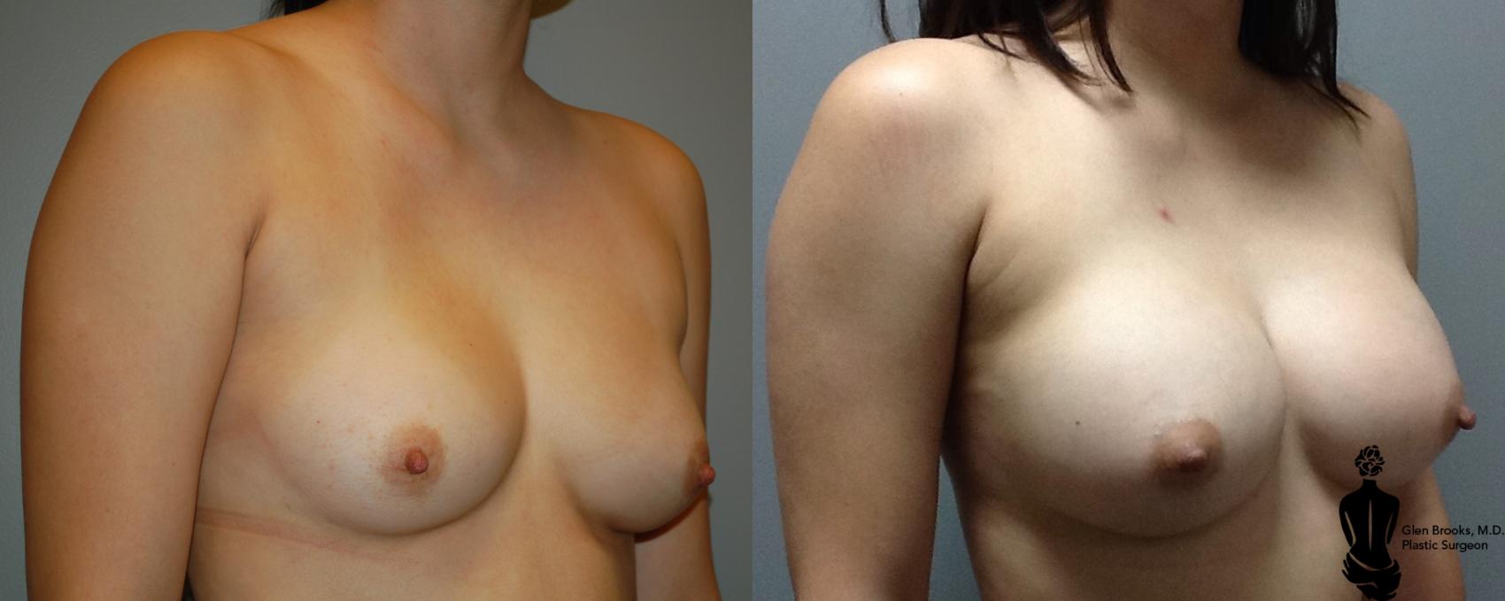 Before & After Breast Augmentation Case 115 View #2 View in Springfield, MA