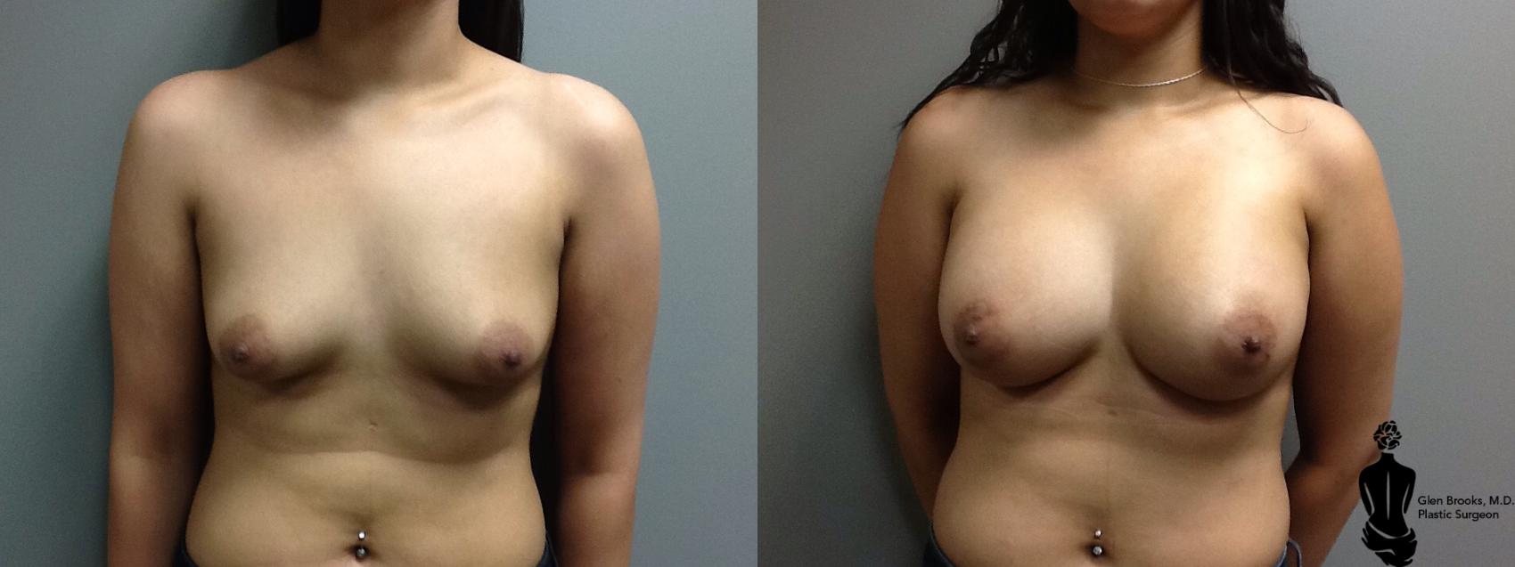 Before & After Breast Augmentation Case 116 View #1 View in Springfield, MA
