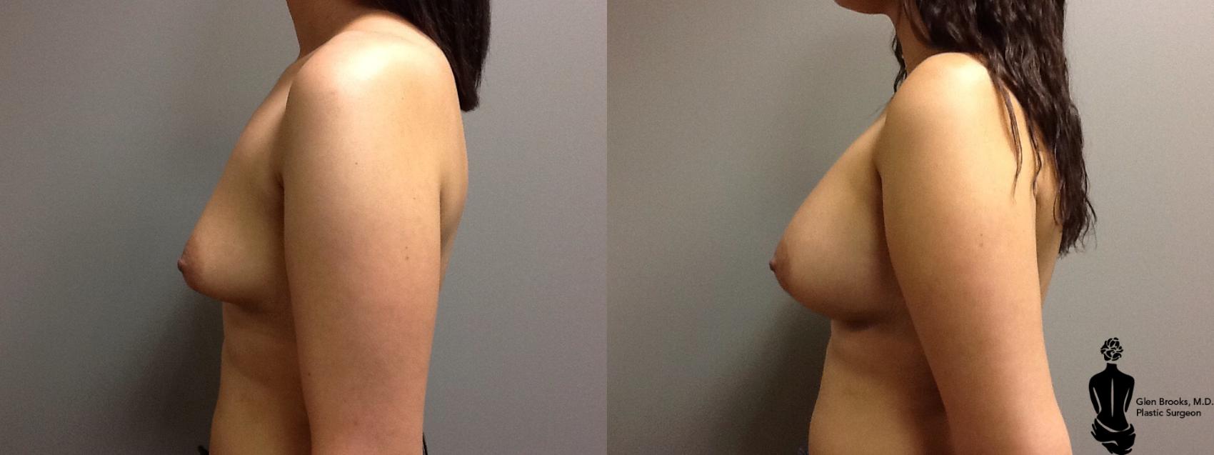 Before & After Breast Augmentation Case 116 View #2 View in Springfield, MA