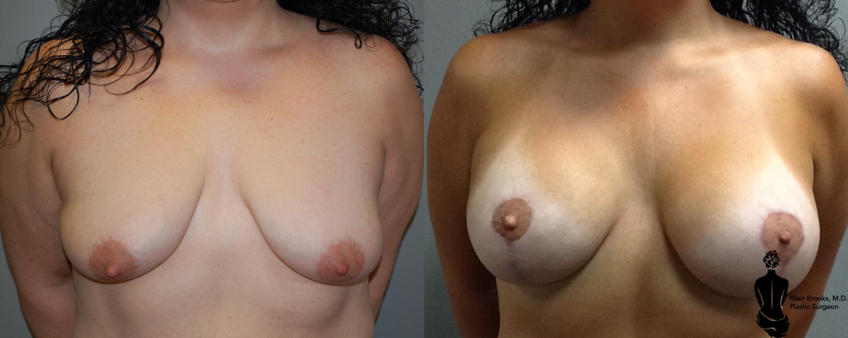 Before & After Breast Augmentation Case 117 View #1 View in Springfield, MA