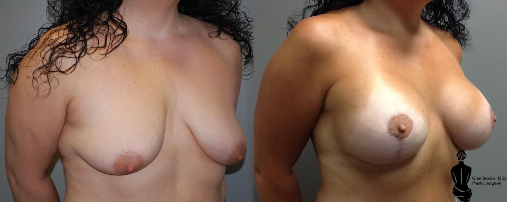 Before & After Breast Augmentation Case 117 View #2 View in Springfield, MA