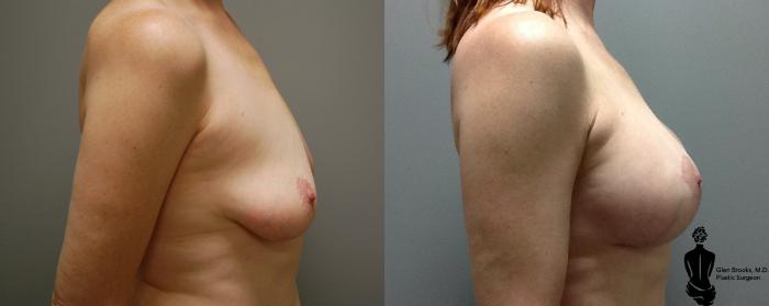 Before & After Breast Augmentation Case 118 View #1 View in Springfield, MA