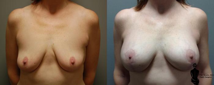 Before & After Breast Augmentation Case 118 View #2 View in Springfield, MA