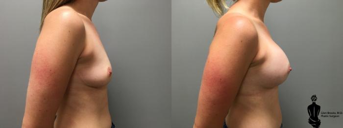 Before & After Breast Augmentation Case 135 View #2 View in Springfield, MA