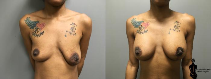 Before & After Breast Augmentation Case 140 View #1 View in Springfield, MA