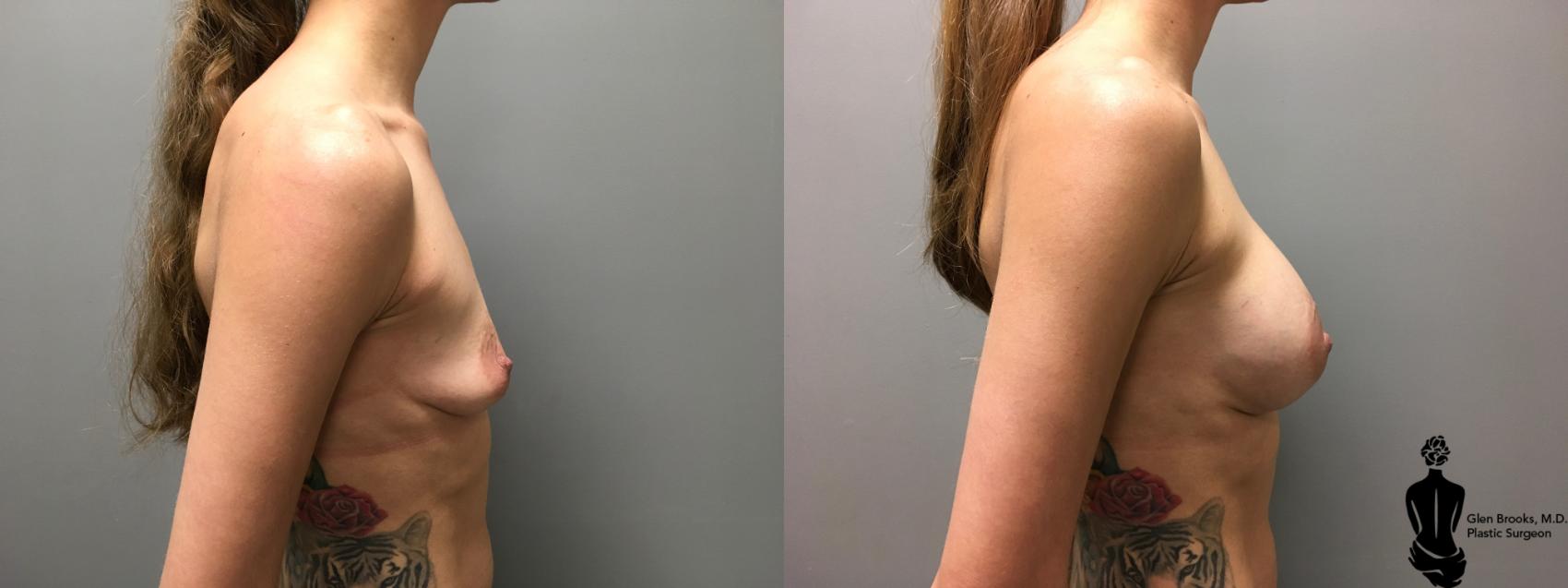 Before & After Breast Augmentation Case 143 View #1 View in Springfield, MA