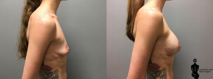 Before & After Breast Augmentation Case 143 View #1 View in Springfield, MA