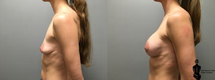 Before & After Breast Augmentation Case 143 View #2 View in Springfield, MA
