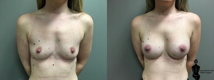 Before & After Breast Augmentation Case 150 View #1 View in Springfield, MA