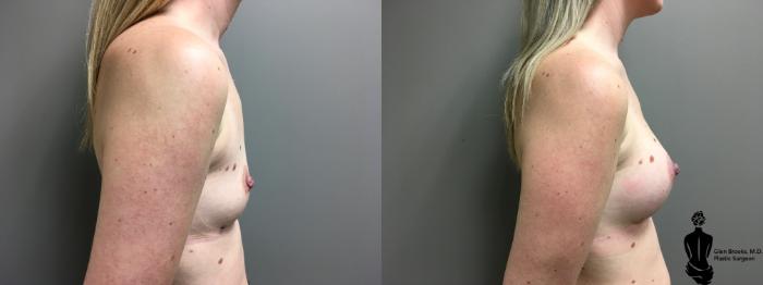 Before & After Breast Augmentation Case 150 View #2 View in Springfield, MA