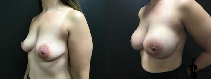Before & After Breast Augmentation Case 155 Left Oblique View in Springfield, MA