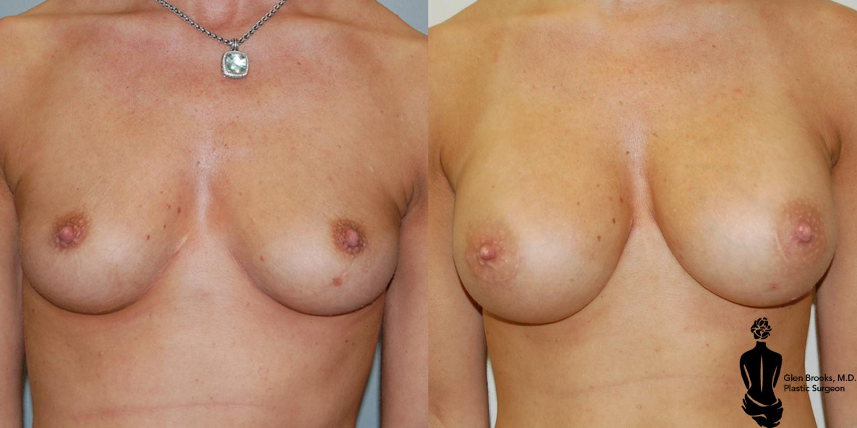 Before & After Breast Augmentation Case 2 View #1 View in Springfield, MA