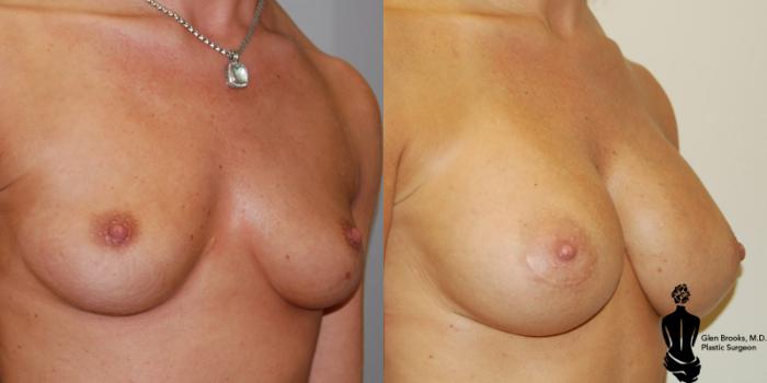 Before & After Breast Augmentation Case 2 View #2 View in Springfield, MA