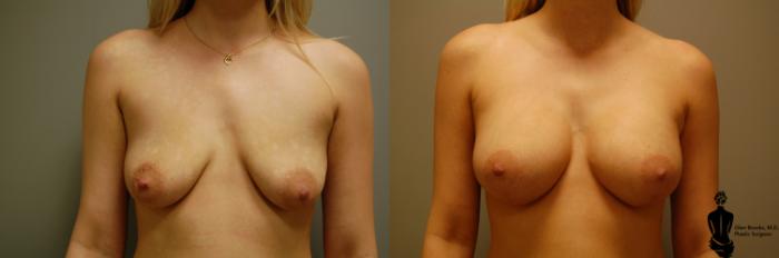 Before & After Breast Augmentation Case 26 View #1 View in Springfield, MA