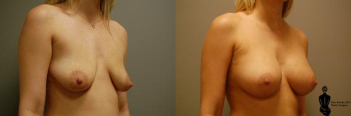 Before & After Breast Augmentation Case 26 View #2 View in Springfield, MA