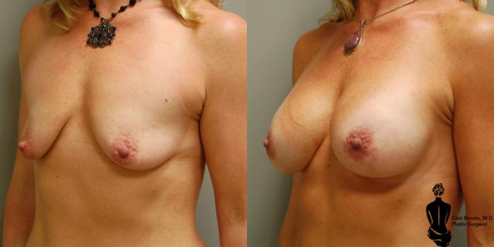 Before & After Breast Augmentation Case 3 View #2 View in Springfield, MA