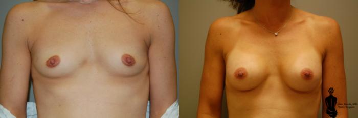 Before & After Breast Augmentation Case 32 View #1 View in Springfield, MA