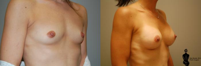 Before & After Breast Augmentation Case 32 View #2 View in Springfield, MA