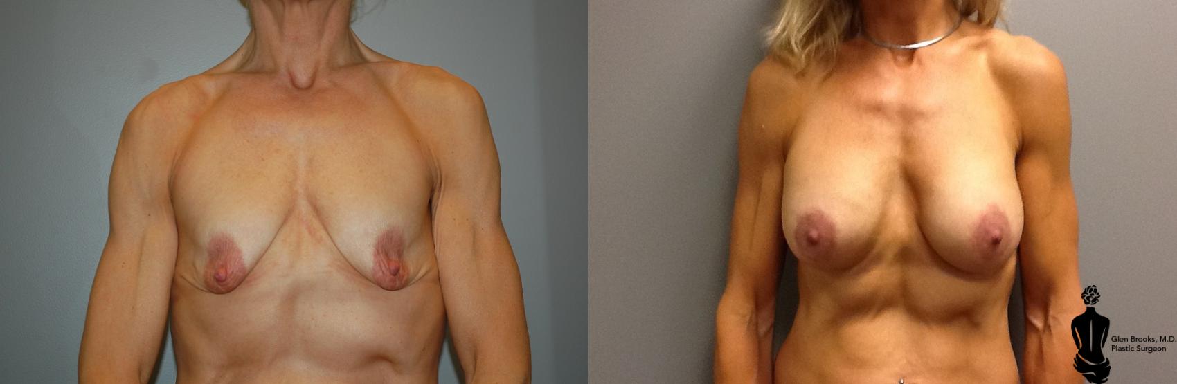 Before & After Breast Augmentation Case 39 View #2 View in Springfield, MA