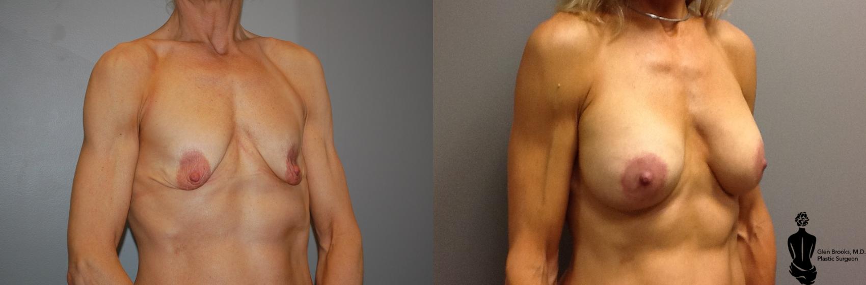 Before & After Breast Augmentation Case 39 View #4 View in Springfield, MA