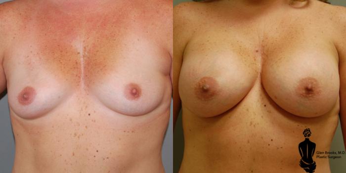 Before & After Breast Augmentation Case 4 View #1 View in Springfield, MA